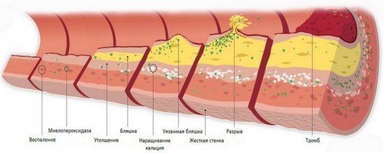 Медикаментозное лечение атеросклероза сосудов головного мозга препаратами