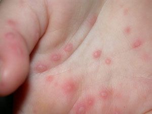 Менингит – симптомы и лечение у детей по видам заболевания