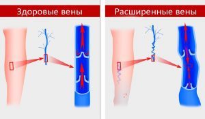 Кдо что это такое | Все о ретикулярном варикозе