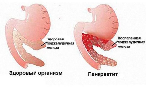 Альфа-амилаза в крови повышена