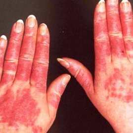 Волчанка - причины, признаки и симптомы, лечение