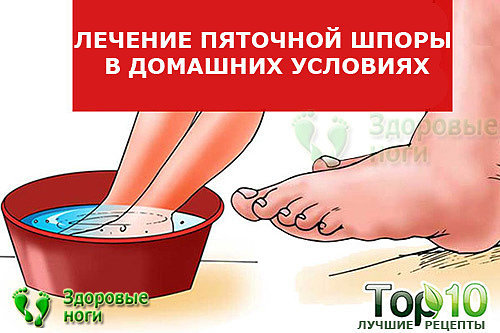 Пяточная шпора - симптомы и лечение в домашних условиях эффективными способами