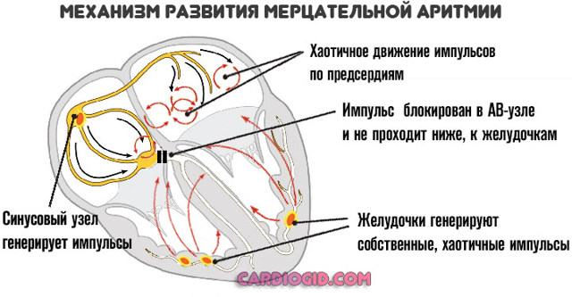 Мерцательная аритмия: причины, симптомы и лечение