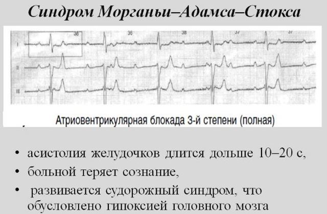 Неполная блокада левой ножки пучка Гиса - причины, лечение