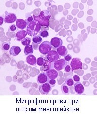 Острый миелоидный лейкоз - причины, симптомы, диагностика и лечение, прогноз