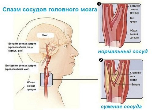 Таблетки от спазма сосудов головного мозга: препараты для лечения и народные средства