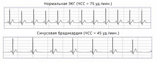 Аритмия сердца: симптомы, причины, лечение