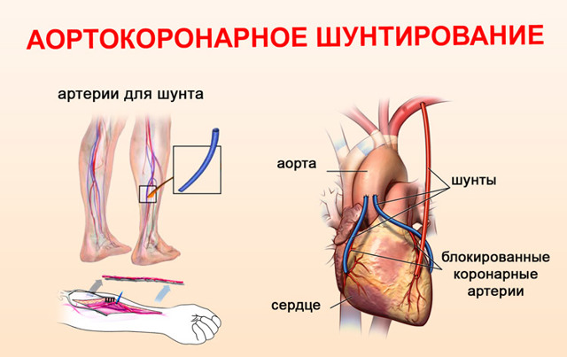 Операция после инфаркта миокарда