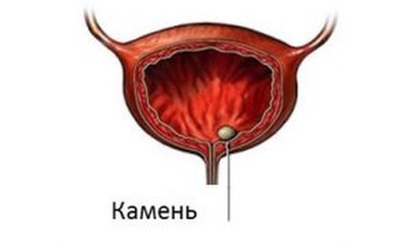 Мочекаменная болезнь симптомы и лечение у мужчин