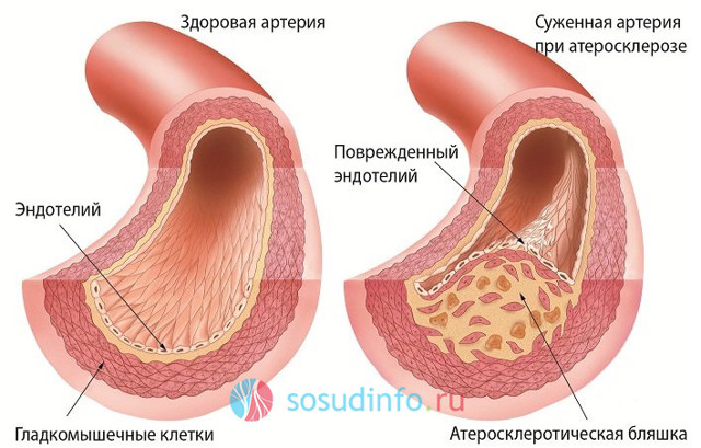 Симтомы, диагностика и лечение закупорки кровеносных сосудов