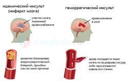 Открытое овальное окно в сердце: у взрослого, что означает