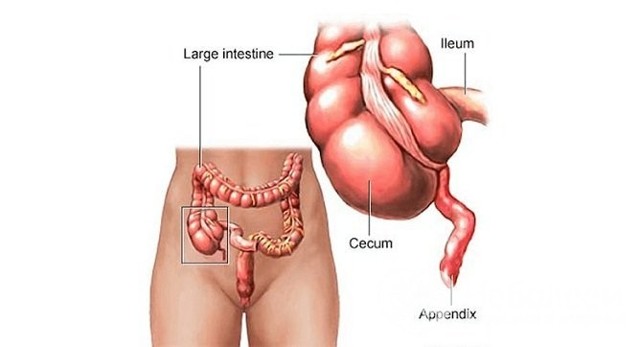 Хронический аппендицит у женщин и мужчин – симптомы, диагностика, лечение