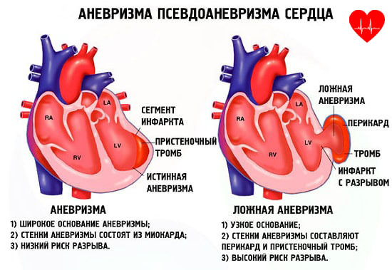 Аневризма сердца - Боль в Сердце
