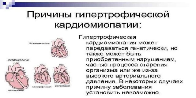Гипертрофическая кардиомиопатия.