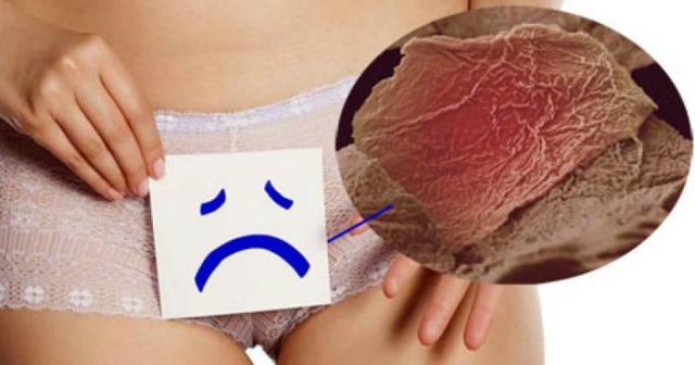 Вульвит у женщин – симптомы и лечение, фото