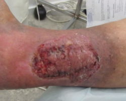 Трофические язвы нижних конечностей: виды, симптомы, лечение