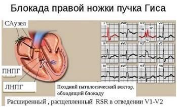 Неполная блокада левой ножки пучка Гиса - причины, лечение