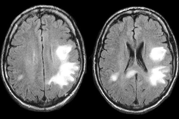 Лейкоэнцефалопатия головного мозга что это такое