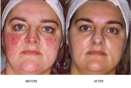 Как убрать красные сосуды на лице в домашних условиях