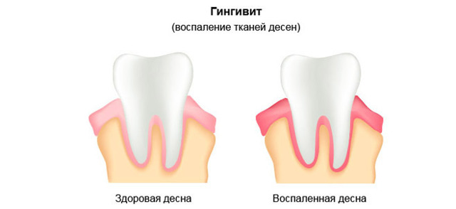 Красные Десна Вокруг Зуба и Болит Что Делать, Как Избавится?