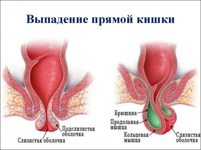 Выпадения прямой кишки — причины у взрослых