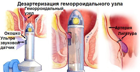 Удаление геморроидальных узлов с помощью разнообразных методик