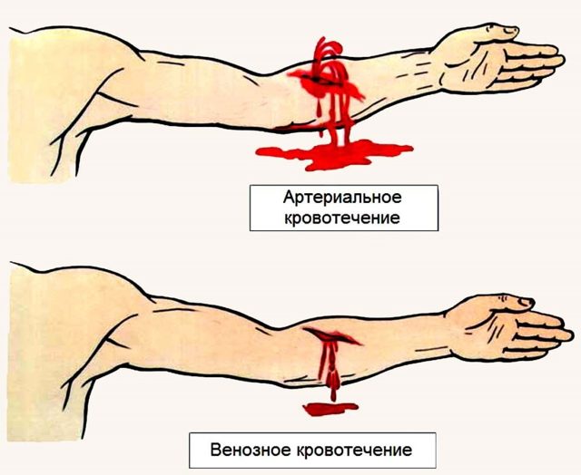 Правила наложения жгута: этапы, особенности, контроль