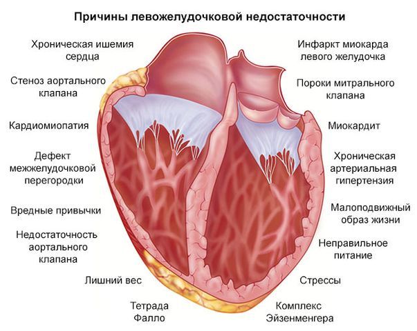 Левожелудочковая недостаточность: симптомы, лечение
