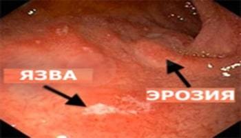 Эрозивный гастрит – симптомы, лечение, диета, осложнения, профилактика