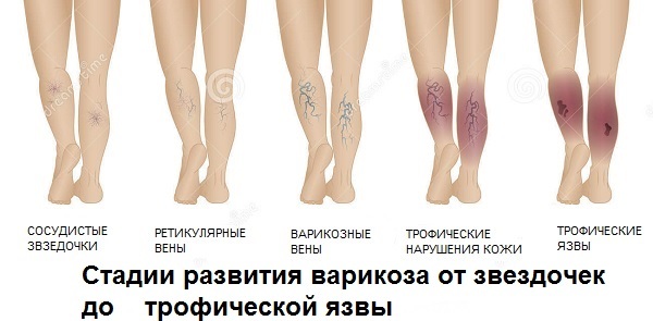 Трофические язвы нижних конечностей: виды, симптомы, лечение