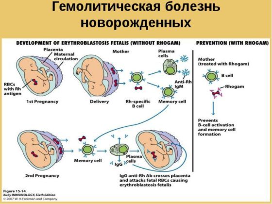 Переливание крови новорожденному при низком гемоглобине