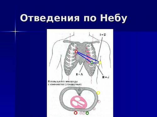 Наложение электродов при ЭКГ: как их накладывать, схема наложения и постановки