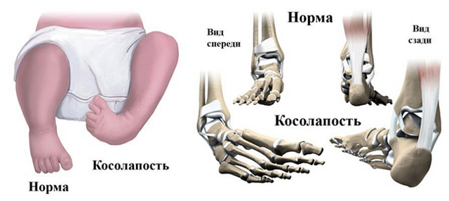 От чего возникает косолапость у детей и как ее эффективно лечить