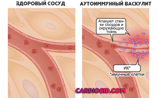 Железодефицитная анемия симптомы