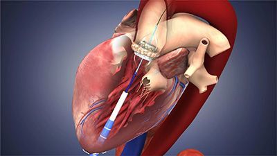 Эндоваскулярное протезирование аортального клапана - ЦЭЛТ