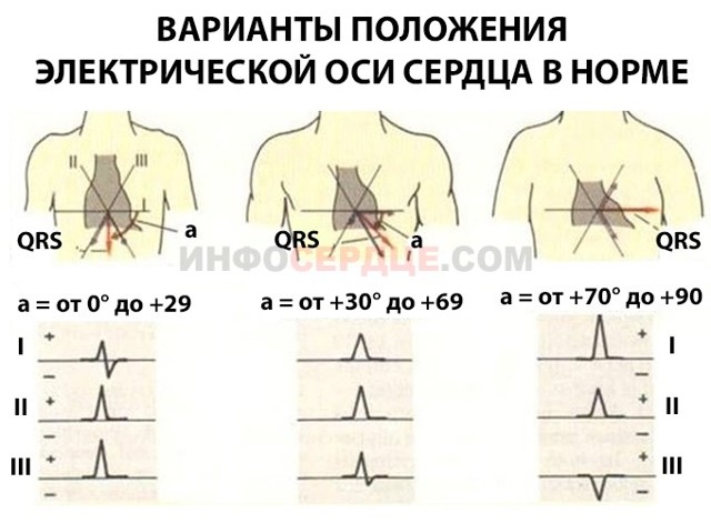Резкое отклонение эос вправо что значит. ЭОС отклонена вправо: осложнения, диагностика и лечение
