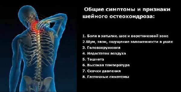 Нарушение мозгового кровообращения при шейном остеохондрозе