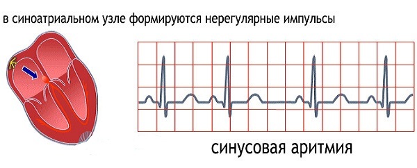 Синусовая (синусоидальная) аритмия сердца - Доктор Кровь