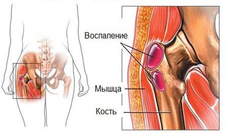 Боль в тазобедренном суставе - причины, симптомы и лечение боли в тазобедренных суставах