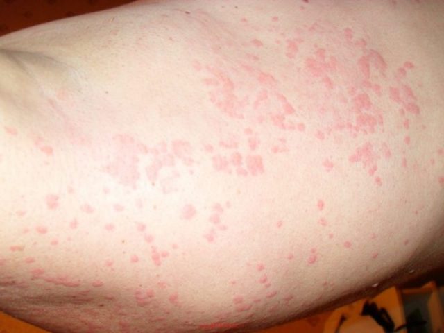 Уфок при аллергии — Все про аллергию