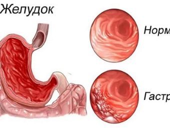 Лечение геморроя в домашних условиях быстро картофелем