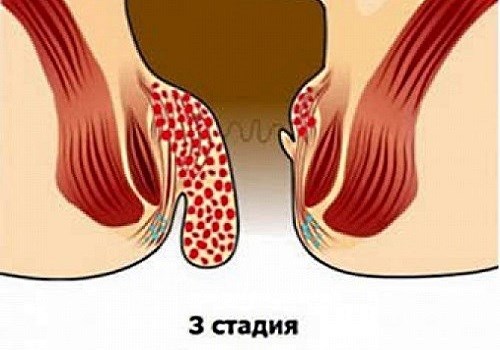 Удаление геморроидальных узлов с помощью разнообразных методик