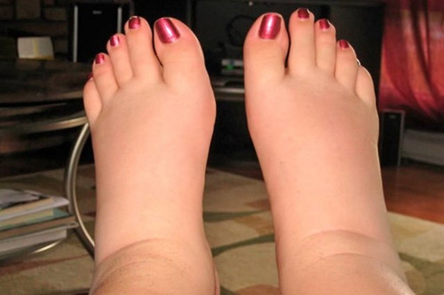 Отеки ног при сердечной недостаточности