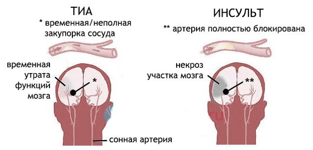 Транзиторная ишемическая атака - за шаг до инсульта.