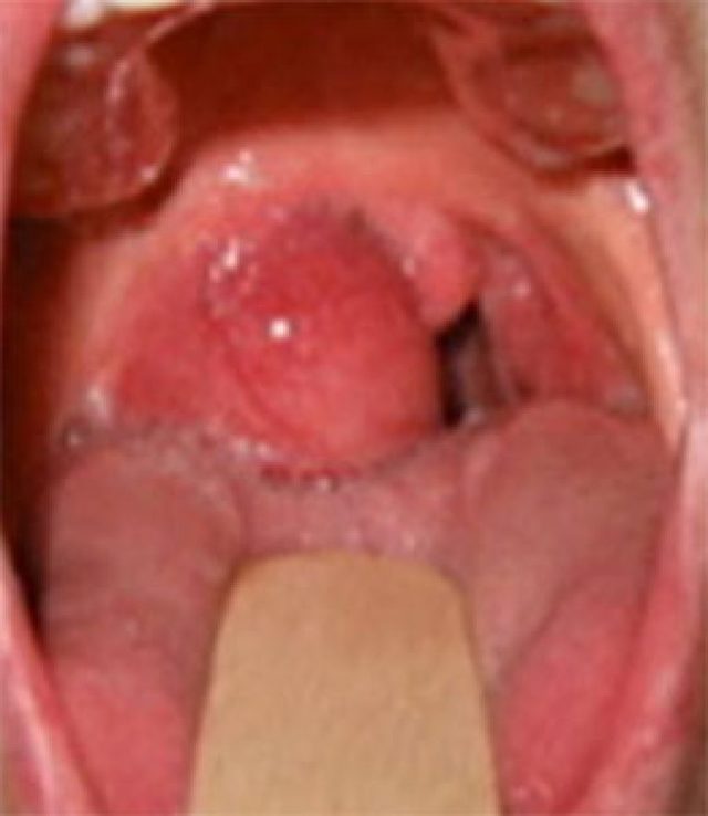 Паратонзиллярный абсцесс: лечение, фото, симптомы