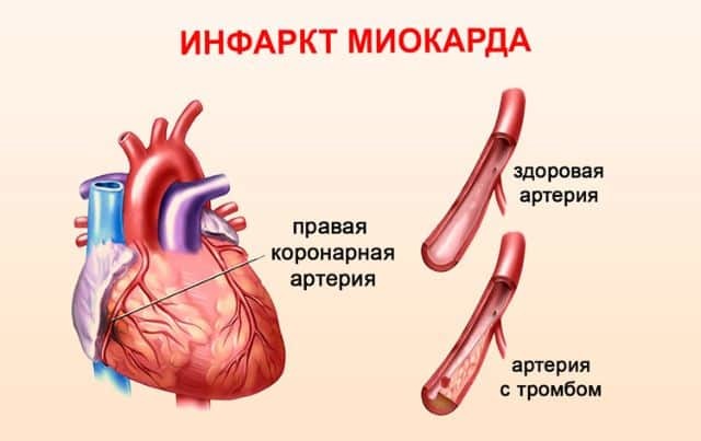 Крупноочаговый инфаркт миокарда