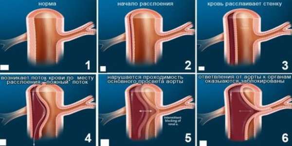Расширение восходящего отдела аорты сердца