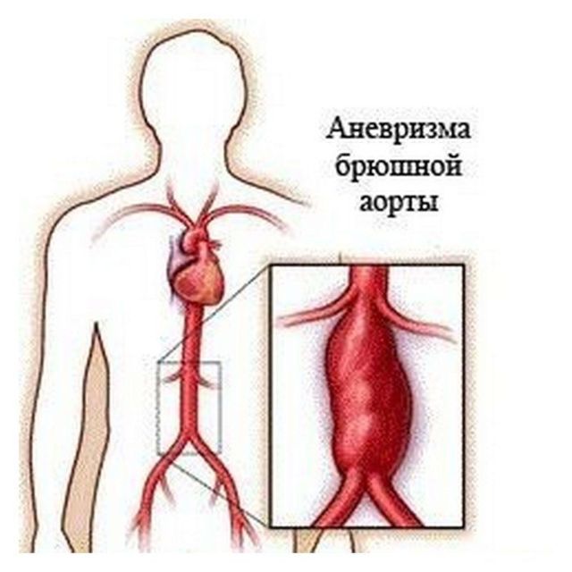 Атеросклероз брюшной аорты
