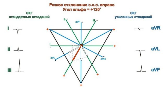 Резкое отклонение эос вправо что значит. ЭОС отклонена вправо: осложнения, диагностика и лечение