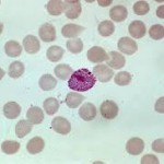 Общий анализ крови - норма и расшифровка результатов в таблицах у детей и взрослых